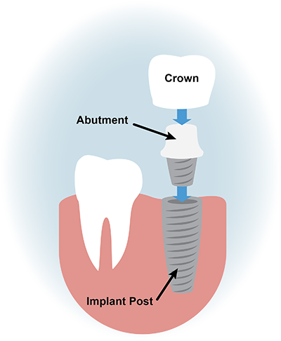 Dental Implant Illustration