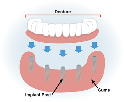 Dentures Illustration