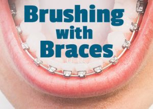 Pineville dentist, Dr. Jonas Gauthier of Today's Dental informs patients about the best tools and tricks to use when performing oral hygiene routines with braces.