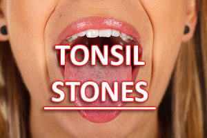 Pineville dentist, Dr. Gauthier at Today's Dental tells patients about what causes tonsil stones and how to treat and prevent them from forming.