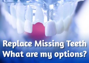 Pineville dentist, Dr. Jonas Gauthier of Today's Dental Pineville discusses the tooth replacement options available to replace missing teeth and restore your smile.