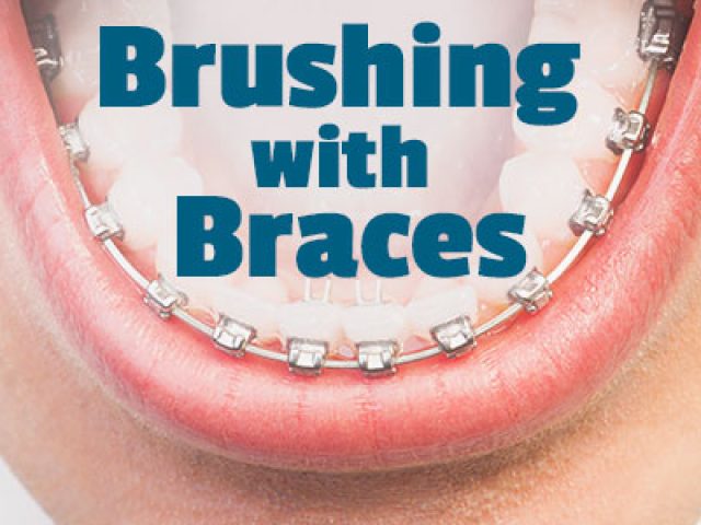 Brushing with Braces: Cleaning Every Nook & Cranny (featured image)