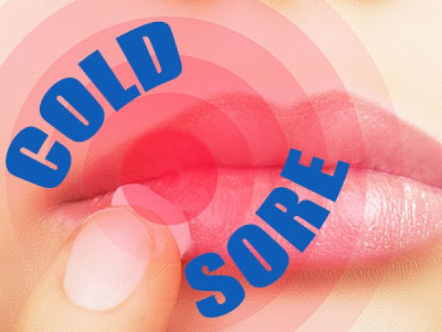 Cold Sores 101 (featured image)